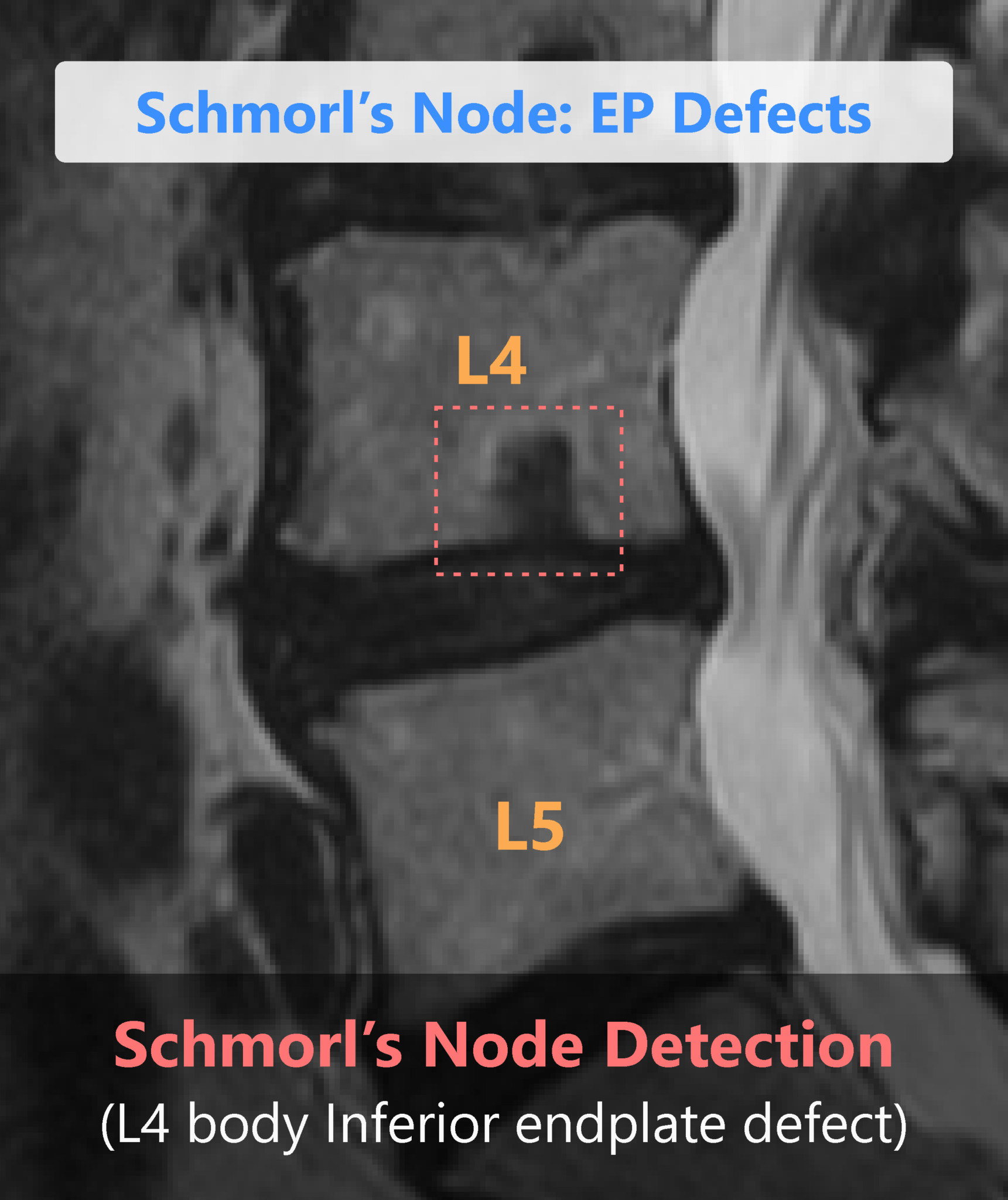 Spindle by Synapsica AI Assistant for MRI Spine Reporting