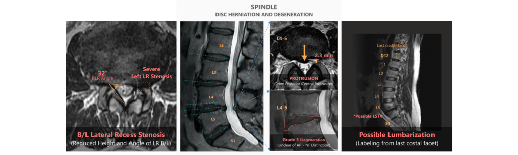 Spindle, a radiology software powered by AI, providing useful insights for radiologist