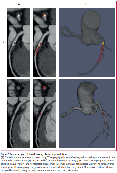 Application of deep learning in predicting the heart diseases