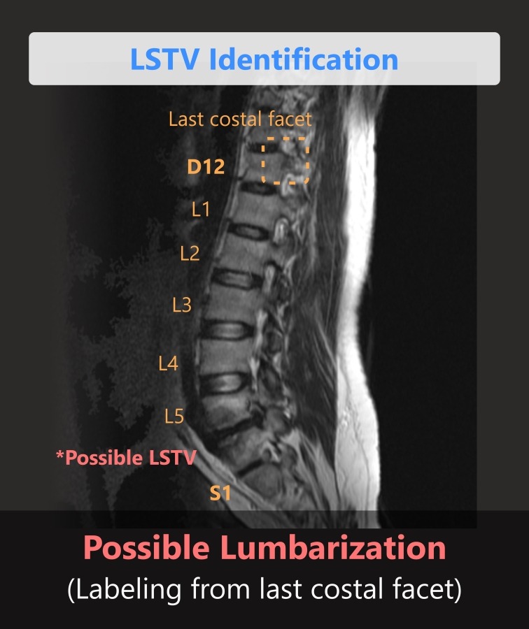 Possible LSTV | Spine reporting by Spindle