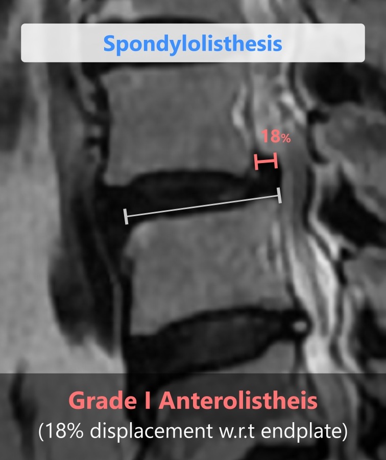 Spondyolisthesis identified by Spindle