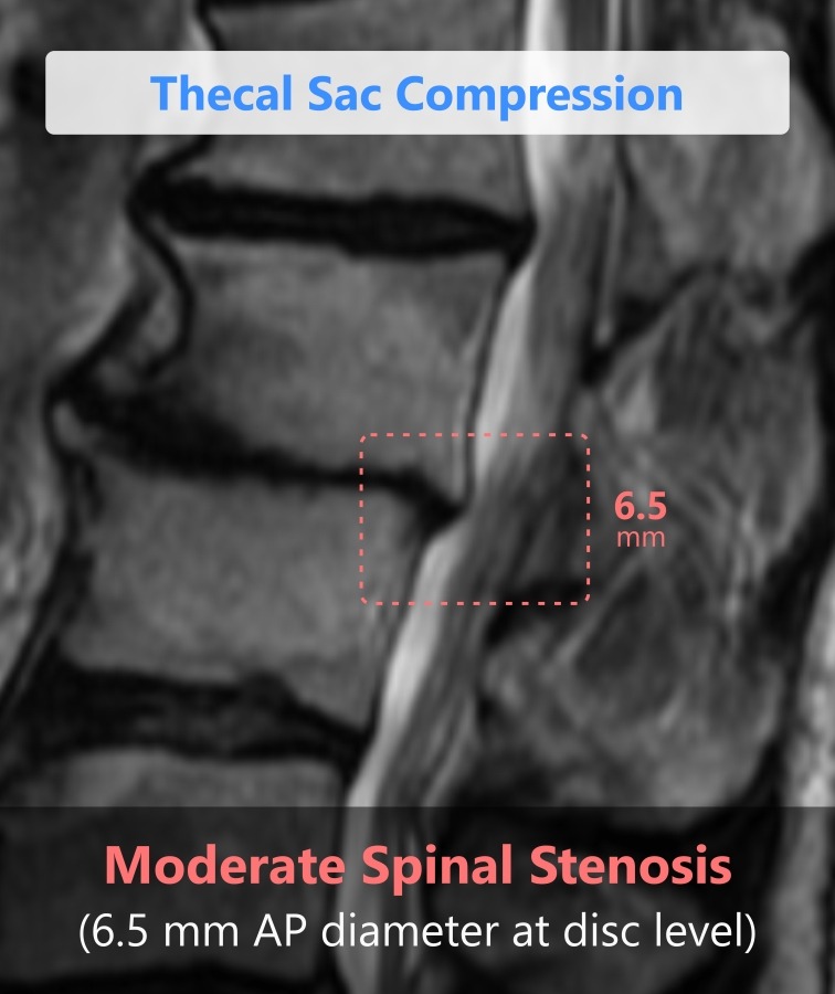 Thecal Sac Compression identified by Spindle